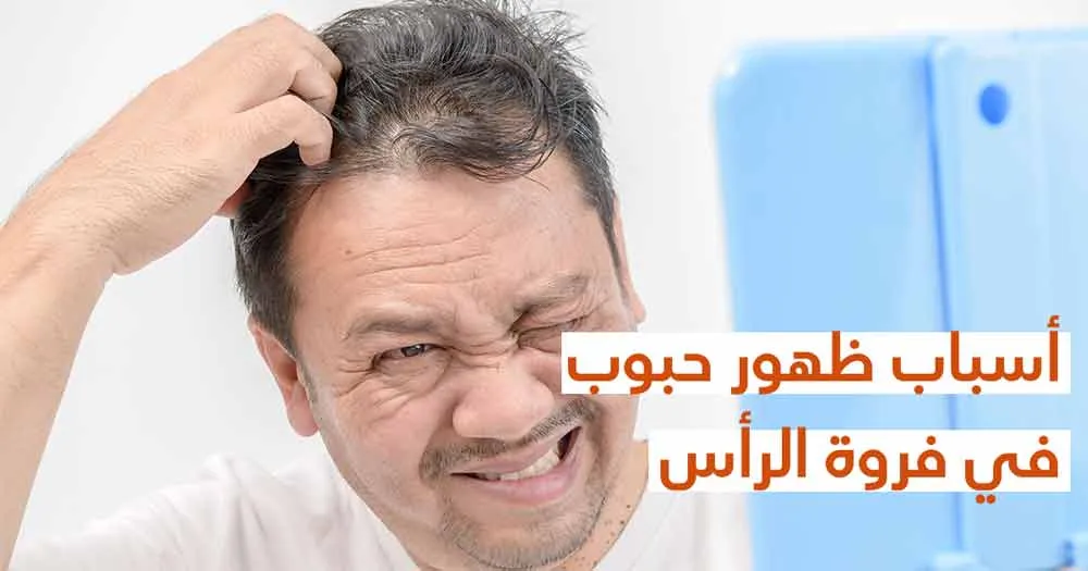 أسباب ظهور حبوب في فروة الرأس